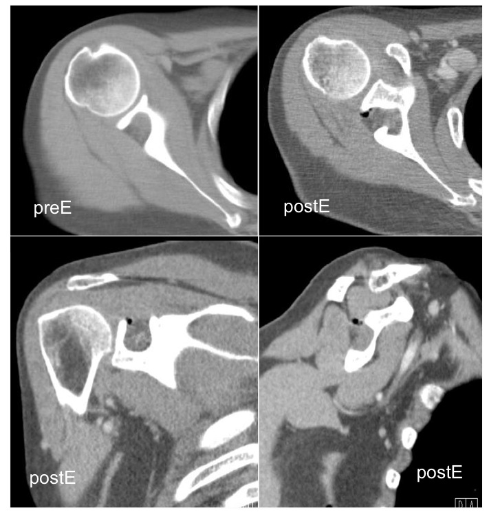 Figure 4 for case inflammatory pseudotumor ( RID3860 )